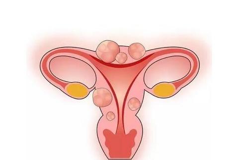 昆明女性怎么知道有了子宫肌瘤 四个方法助你判断